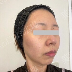 白玉ハイパー点滴（高濃度グルタチオン1200㎎）の治療前の症例写真