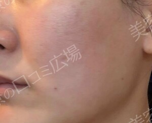 治療直後の症例写真
