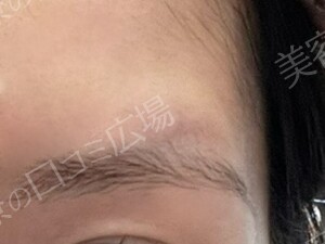 【口コミ広場期間限定価格】韓国製ボトックス｜1部位の治療前の症例写真