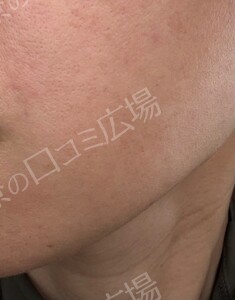 治療直後の症例写真