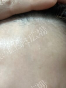 治療直後の症例写真