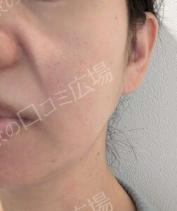 医療ハイフ｜頬・フェイスラインのたるみの治療前の症例写真