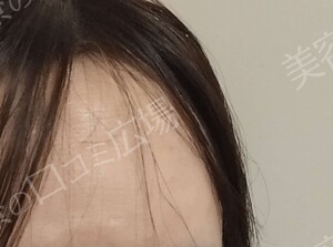 治療直後の症例写真