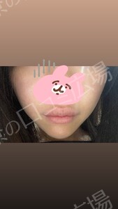 ララドクター｜低刺激ピーリング｜ララピール進化版の治療結果の症例写真