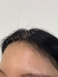 治療直後の症例写真