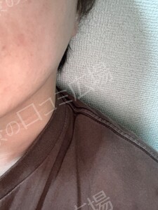治療直後の症例写真