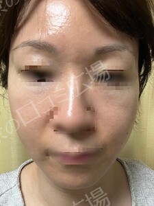 治療直後の症例写真
