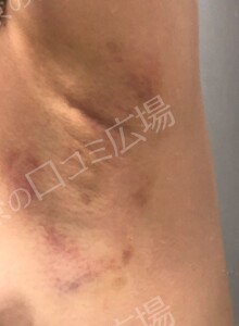 治療直後の症例写真