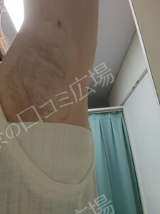 ミラドライ 両わき 1回 レベル８＋部分重複照射の治療直後の症例写真