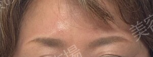 治療直後の症例写真