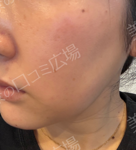 【高崎院限定】初回限定：無料✨｜ピコトーニング｜全顔1回の治療結果の症例写真