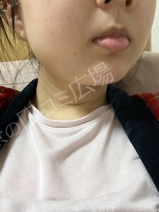 治療直後の症例写真