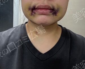 治療直後の症例写真