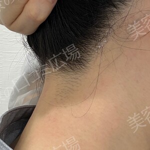 うなじ脱毛1回｜新宿院：ジェントルマックスプロプラスの治療直後の症例写真