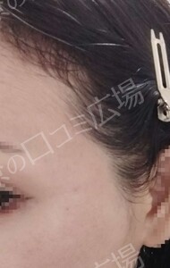 治療直後の症例写真