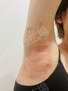 治療直後の症例写真