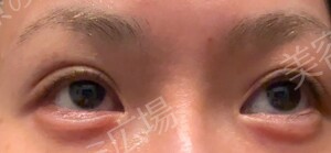 治療直後の症例写真