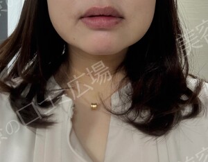 治療直後の症例写真