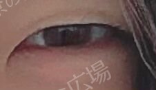 【学生限定】LS法ダブルスタンダードプラン　両目の治療前の症例写真