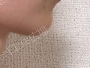 ルラ（LULA）美容クリニック 岡山院の症例写真[アフター]