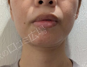 さっぽろ美容クリニック 本院の症例写真[アフター]