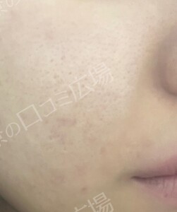 ララドクター｜低刺激ピーリング｜ララピール進化版の治療前の症例写真