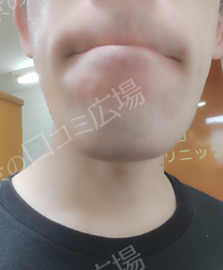 治療直後の症例写真