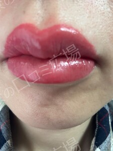 リップ ＆ アイライン上下 アートメイク 2回 モニター施術の治療直後の症例写真
