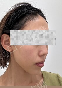 治療直後の症例写真