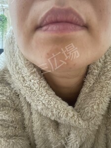 治療直後の症例写真