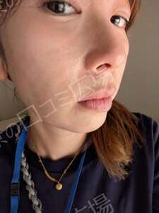 治療結果の症例写真