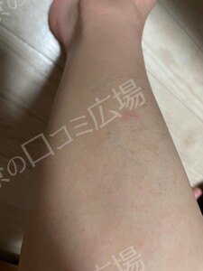 治療前の症例写真