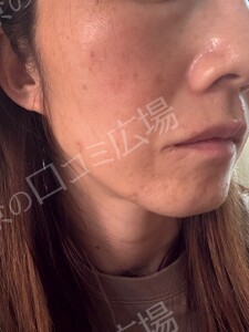 治療直後の症例写真