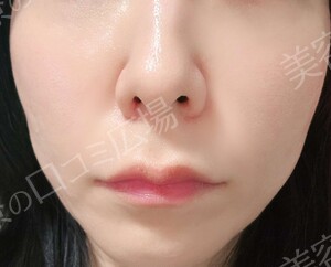 治療直後の症例写真