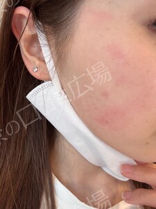 イオン導入｟リピーターOK｠の治療直後の症例写真