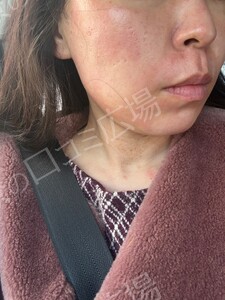 治療直後の症例写真