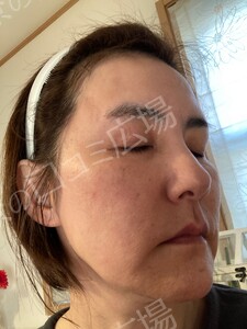 治療結果の症例写真