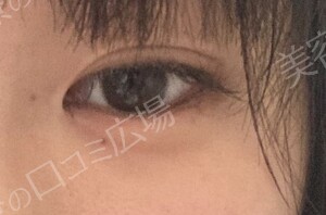 治療直後の症例写真