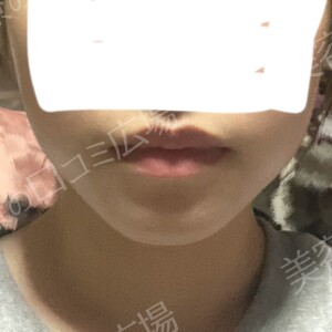 治療直後の症例写真