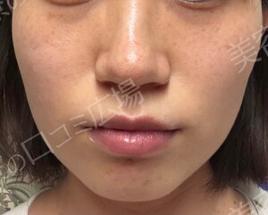 エバーグリーンメディカルクリニックのシミ取り・肝斑・毛穴治療の症例写真[ビフォー]