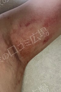 治療直後の症例写真