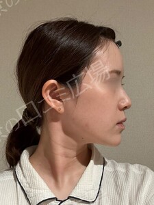 貴族手術（鼻翼基部プロテーゼ）｜ほうれい線を改善の治療結果の症例写真