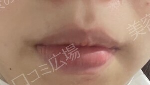 治療直後の症例写真