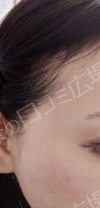 治療直後の症例写真