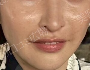 治療直後の症例写真