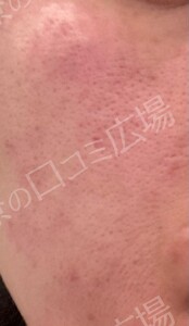 治療直後の症例写真