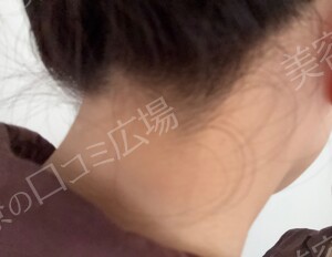 治療直後の症例写真