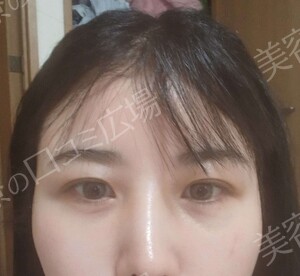 【おすすめ！】　涙袋ヒアルロン酸（0.1㏄）の治療直後の症例写真