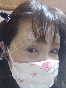 治療直後の症例写真