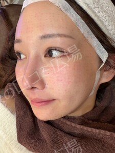 治療直後の症例写真